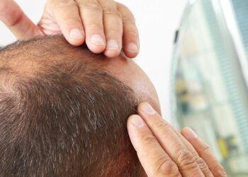 علماء صينيون يكشفون عن لصاقة تعالج الصلع خلال شهر واحد